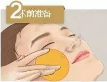 埋线提升,早做和晚做的区别到底有多大!