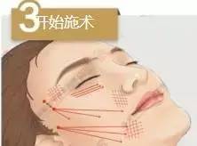 埋线提升,早做和晚做的区别到底有多大!