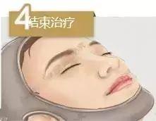 埋线提升,早做和晚做的区别到底有多大!
