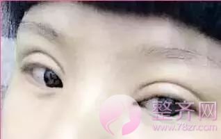 为什么亚洲人不适合做宽的双眼皮?