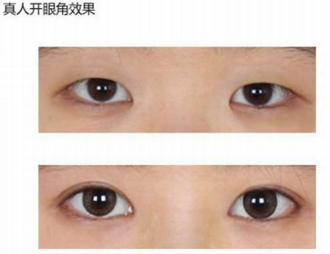 开眼角手术怎么样?多少钱?到底要不要开眼角?