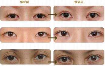 双眼皮失败了如何修复?价格多少钱?