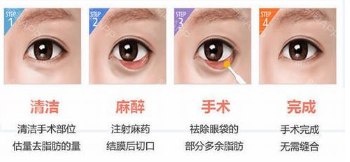 内切祛眼袋果好不好?多少钱?