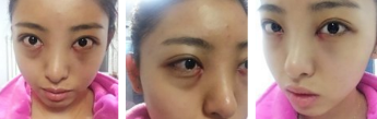 激光祛眼袋果怎么样?多少钱?