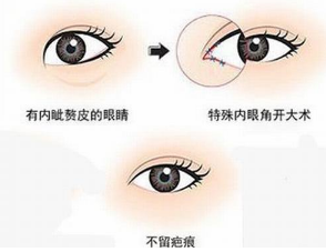 你真的适合开眼角吗?