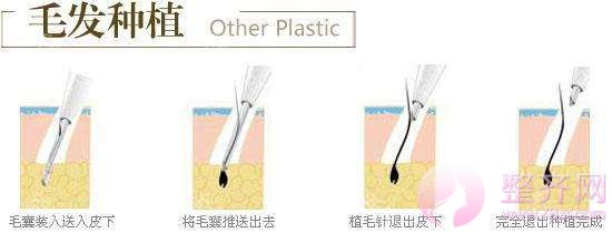 不要担心无法拥有“北极星”绿,植发来帮你