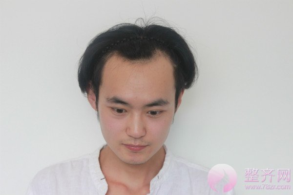 不要担心无法拥有“北极星”绿,植发来帮你
