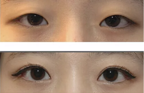 单眼皮不好看,做个双眼皮就漂亮了?这样做美