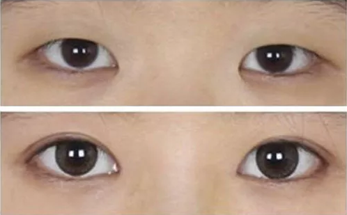 单眼皮不好看,做个双眼皮就漂亮了?这样做美