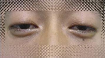 单眼皮不好看,做个双眼皮就漂亮了?这样做美