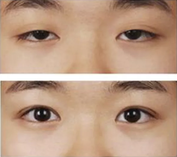 单眼皮不好看,做个双眼皮就漂亮了?这样做美