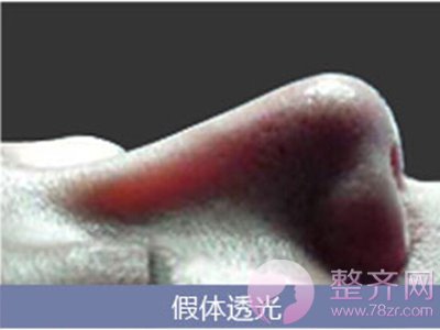 硅胶假体隆鼻后,鼻尖发红、鼻背透光怎么办?