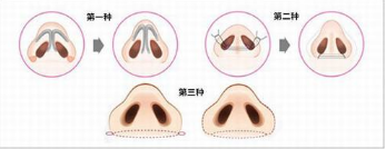 手术缩小鼻翼多少钱?