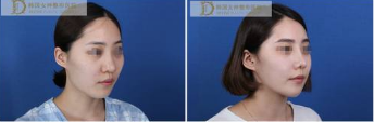 手术缩小鼻翼多少钱?