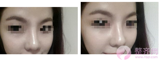 隆完鼻,上镜女神就是你!