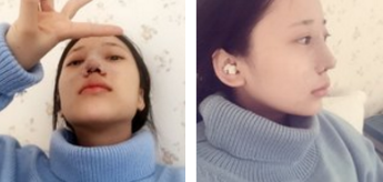 鼻骨矫正需要多少钱？