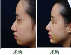 什么是软骨缝合法鼻小柱延长?多少钱?