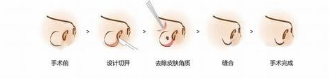 鼻头缩小是怎么样的?价格多少钱呢?