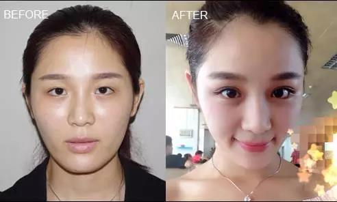 看这些网红的眼睛,就知道她们整形前后变化有