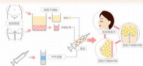 深圳鹏爱李罡自体脂肪隆胸多少钱？好不好？