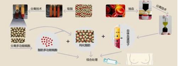 北京叶子李明自体脂肪隆胸多少钱?怎么样?
