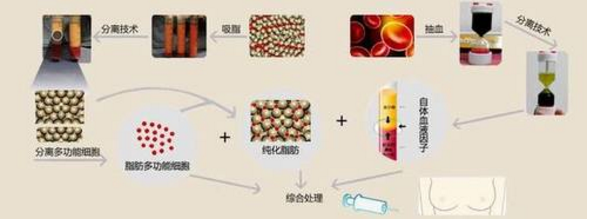 北京叶子李明自体脂肪隆胸多少钱？怎么样？