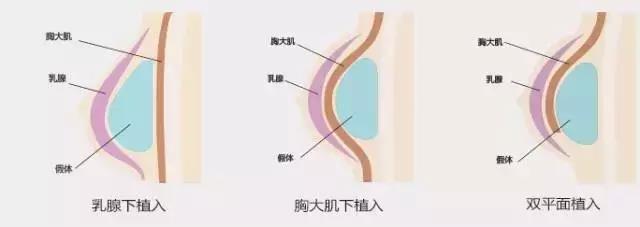 隆胸,究竟能不能瞒过火眼金睛的“老司机”?