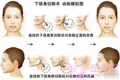 什么脸型适合做下颌角整形?