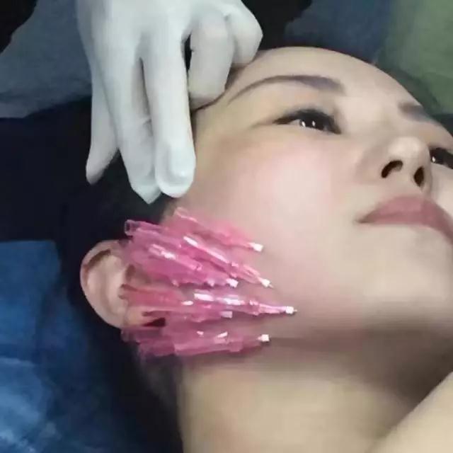 喜武的看射雕,爱酒的喝花雕,怕老的做埋线提升…