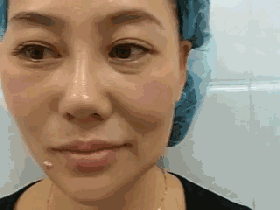 喜武的看射雕,爱酒的喝花雕,怕老的做埋线提升…