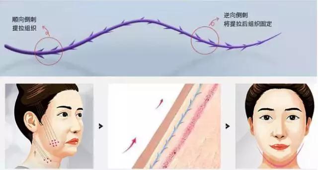 喜武的看射雕,爱酒的喝花雕,怕老的做埋线提升…