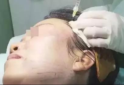 喜武的看射雕,爱酒的喝花雕,怕老的做埋线提升…