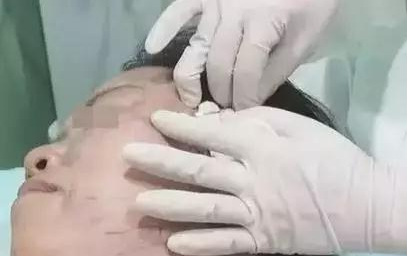 喜武的看射雕,爱酒的喝花雕,怕老的做埋线提升…