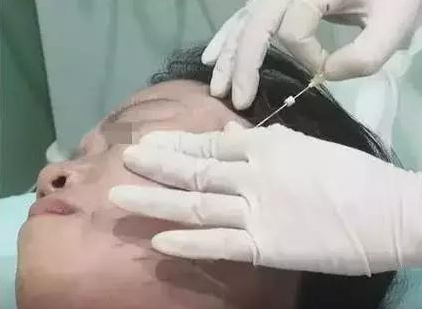 喜武的看射雕,爱酒的喝花雕,怕老的做埋线提升…