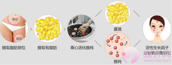 自体脂肪丰胸——瘦身丰胸·一举两得!