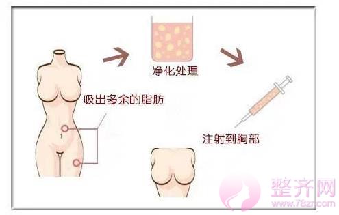 自体脂肪丰胸——瘦身丰胸·一举两得!