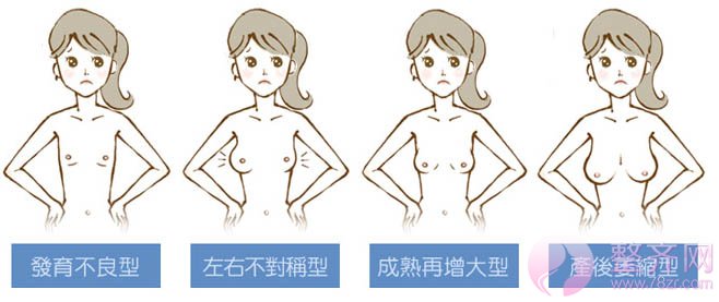 自体脂肪丰胸——瘦身丰胸·一举两得!