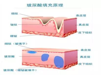 玻尿酸代谢之后皮肤会怎么样?