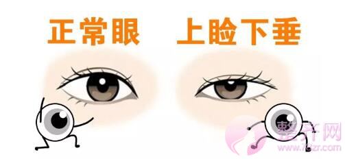 天生的双眼皮为什么不明X?