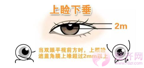 天生的双眼皮为什么不明X?