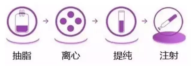 自体脂肪填充,人类自给自足的高级!