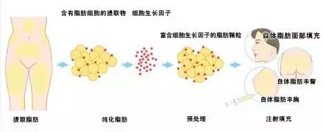 自体脂肪填充,人类自给自足的高级!