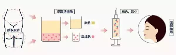 自体脂肪填充,人类自给自足的高级!