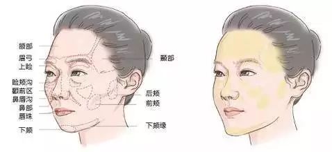 自体脂肪填充,人类自给自足的高级!