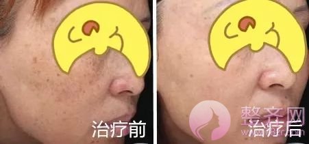 超激光美肤,带你揭开明星们的净肤秘密!