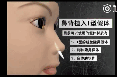 眼下流行的韩式小翘鼻,你真能hold的住吗?