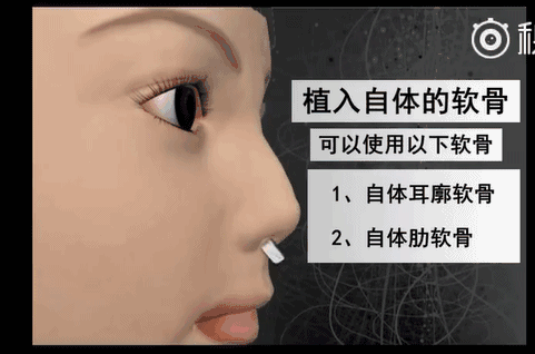 眼下流行的韩式小翘鼻,你真能hold的住吗?
