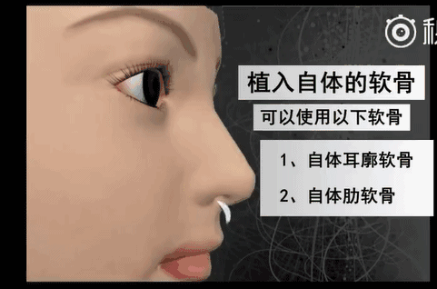 眼下流行的韩式小翘鼻,你真能hold的住吗?