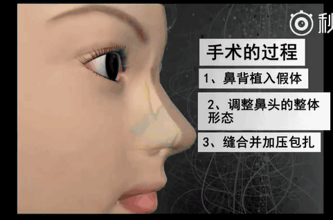 眼下流行的韩式小翘鼻,你真能hold的住吗?