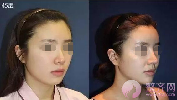 眼下流行的韩式小翘鼻,你真能hold的住吗?
